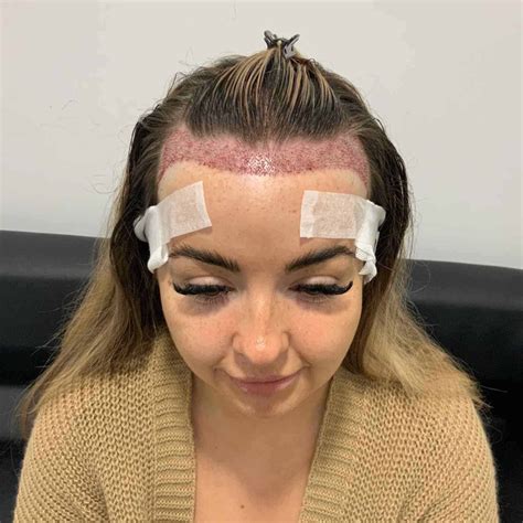 Hair Thinning in Front? Here’s What to Do