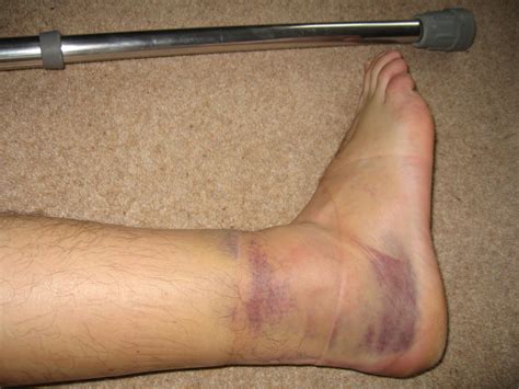 Ever sprained your ankle? - intraining Running Centre