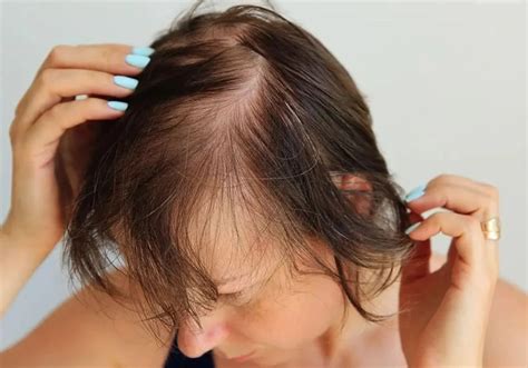 how to stop hair loss after surgery