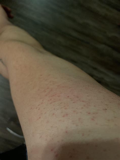 Bumps On Forearms Keratosis Pilaris: How To Get Rid Of Chicken Skin