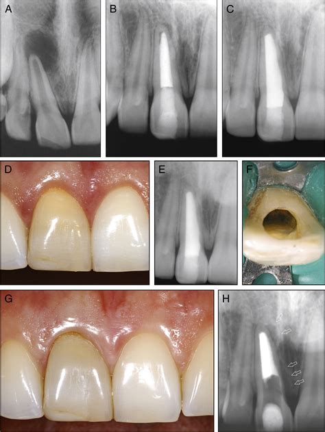What Is Endodontic Failure at Donald Altman blog