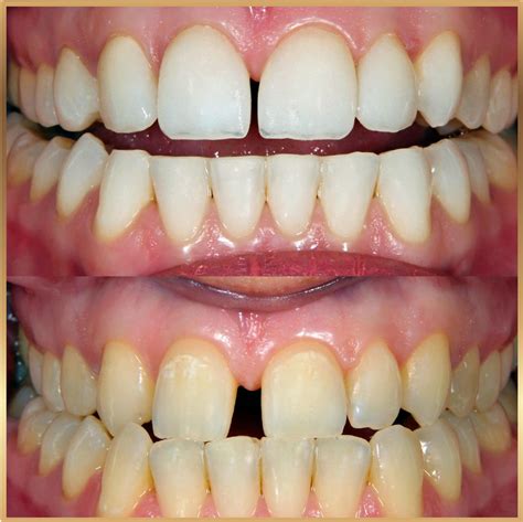 dental gaps treatments kayla medical center