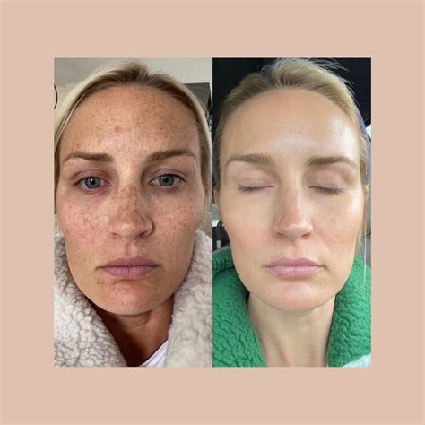 pigmentation treatment london