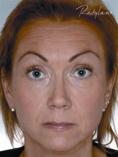 CLÍNICA DOCTORA PAEZ | Sobre el Restylane Vital Light