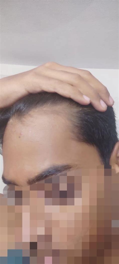 how to regrow hair on temples