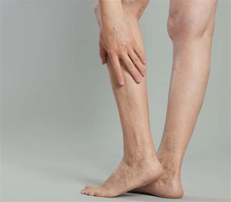 Spider Veins Edison | Spider Vein Treatment in Glen Rock | NJ Vein