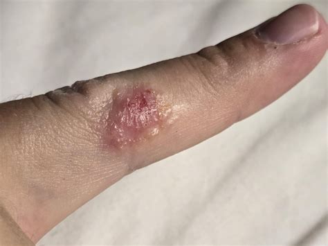 Why is my skin falling off : r/DermatologyQuestions