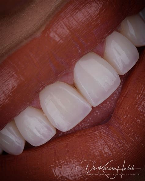 Cost Of Dental Composite Veneers at Ann Burkett blog