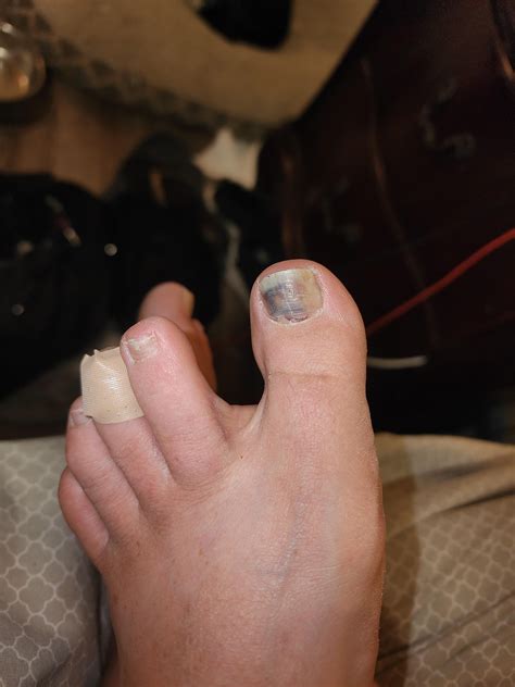 damaged toenail, 2 months, time for doctor? : r/Thruhiking
