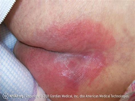 Quick Facts:Pressure Sores - MSD Manual Consumer Version