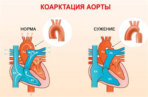 Что такое коарктация аорты - классификация, лечение, прогноз - DavlenieNorm