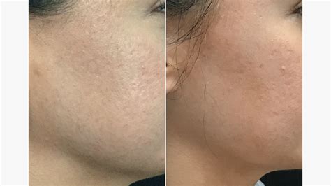 Dermal Fillers Cause Acne - Infoupdate.org