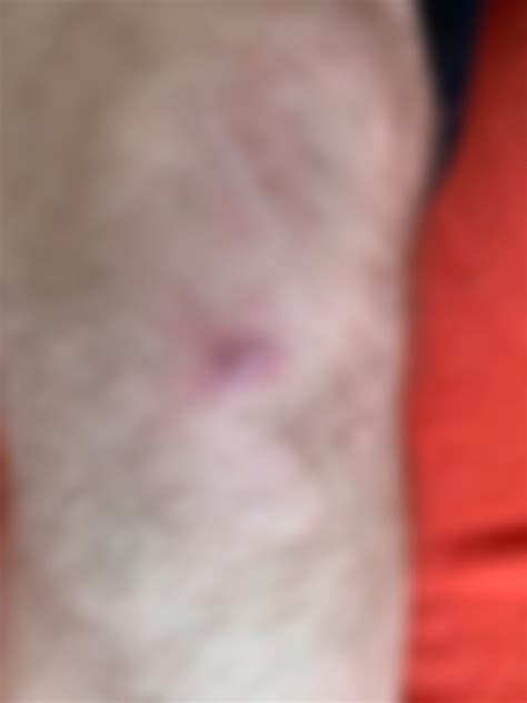 Extremely sensitive bump on my knee. Hard exterior. Not a pimple/zit
