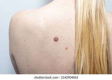 Mole Warts Papilloma On Skin Back Stock Photo 2142904063 | Shutterstock
