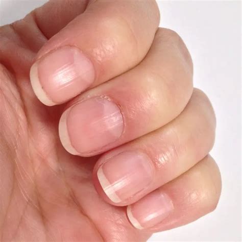 3 signs of anemia for self-checks | Snappy Living
