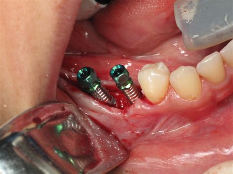 Dental Implant Placement Steps at Jessica Bullard blog