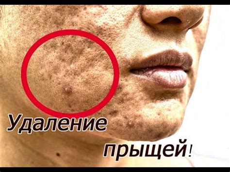 Удаление прыщей! Смотрите "выдавливая прыщи"! прыщи очень выдавливают ...