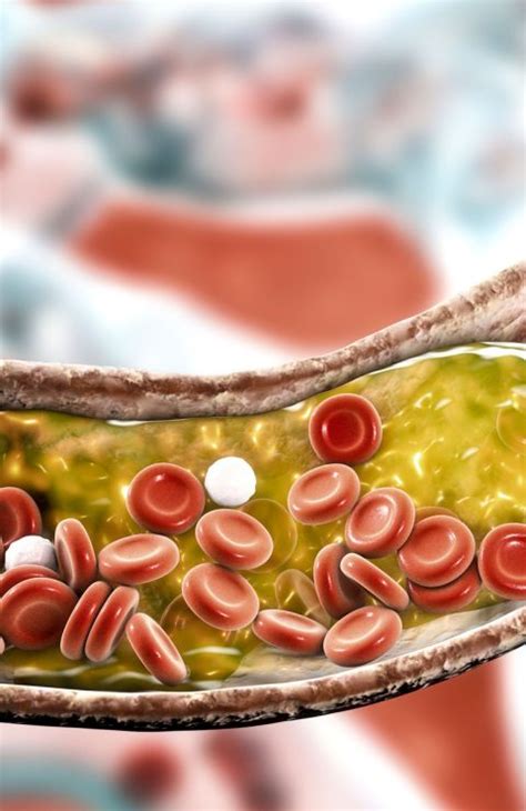 About ASCVD | Invisible Nation