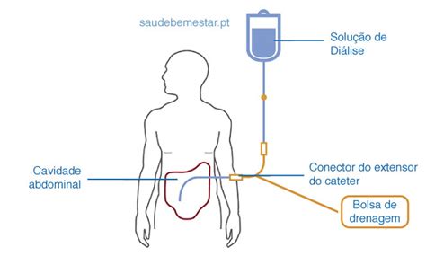 Dialise Peritoneal O Que É