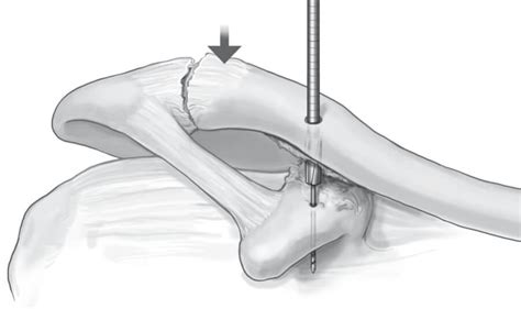 Double Endobutton Technique for Repair of Complete Acromioclavicular ...