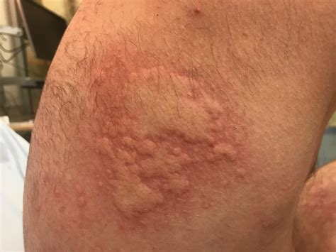 Can You Be Allergic To Food Coloring [2025]