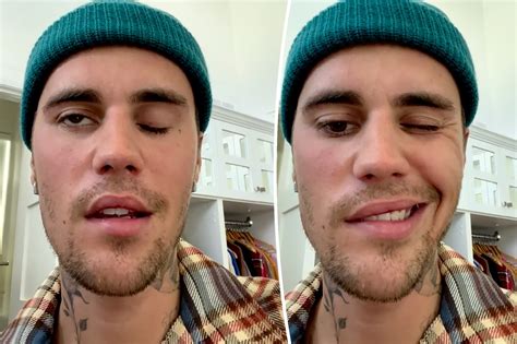 justin biebers face paralyzed  rare disorder diagnosis
