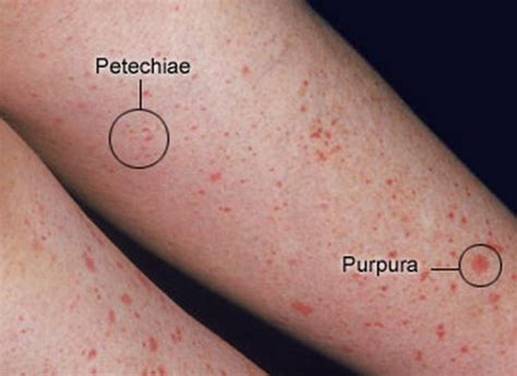 Difference between Petechiae, Purpura and Ecchymoses | Medical Laboratories