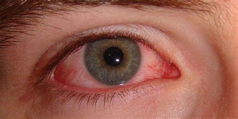 how to know if you're getting pink eye