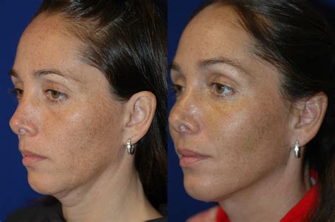 how much does it cost to do liposuction