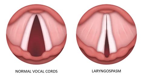 vocal cord spasm jessica parmley