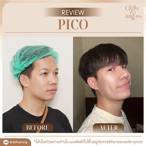 Unbelievable Blackhead Removal 2024: My Honest Review & Before/After Pics. Image 14