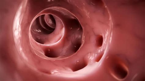 fast  quiz diverticulitis key aspects page