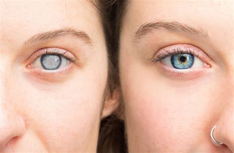 can you drive 2 days after cataract surgery - Lot Of E-Journal Photography
