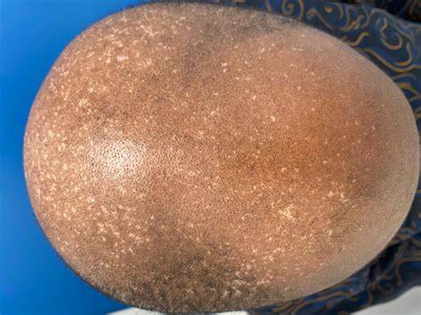 Epidermodysplasia Verruciformis Workup Laboratory Studies