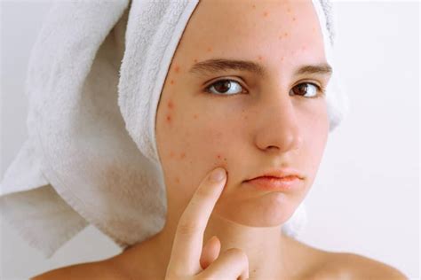 O Que É Bom Para Acnes - Bepantol é Bom Para Acne? - Blog Da Saúde