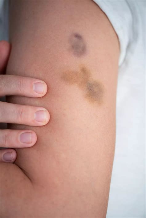 doctor explains   people  frequent  unexplained bruising