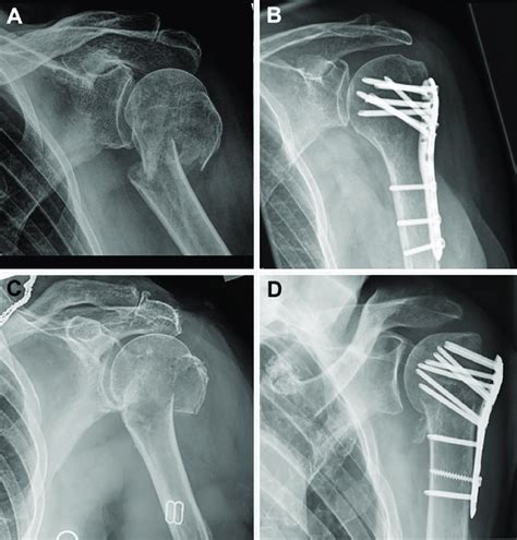 AO 11-A3 fractures before and after ORIF by locking plate. (A)+(B ...