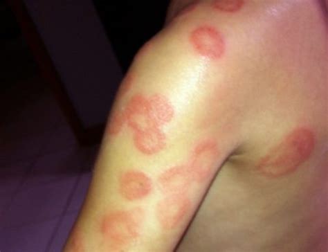 discoid eczema Archives - Almurshidi Medical Tourism - Best Affordable ...
