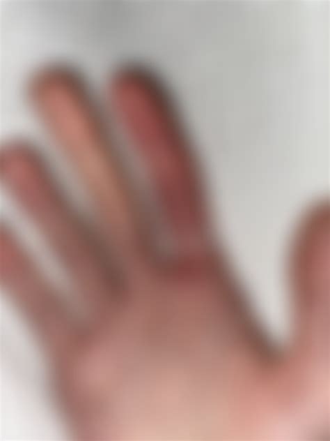 cut finger is swollen