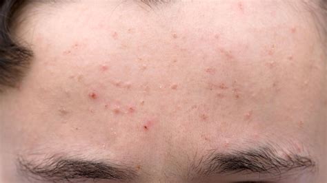 Espinhas Na Testa O Que Pode Ser - Espinhas no rosto: como tratar e como evitar?