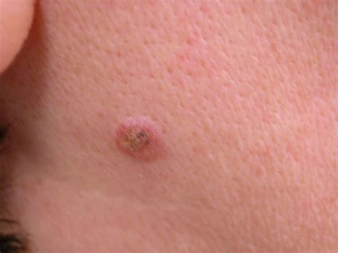 Mole - Atypical Moles - Chicago Plastic Surgery