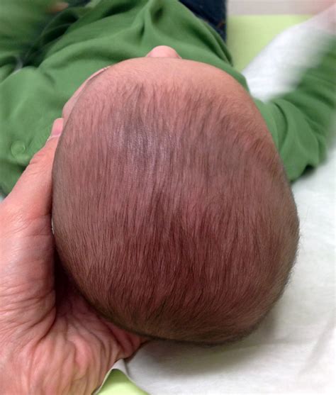 Plagiocephaly, Nonsynostotic