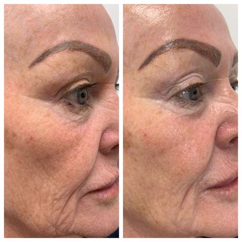 WOW Fusion Treatments, Gravesend, Kent • Laser & Aesthetic Clinic