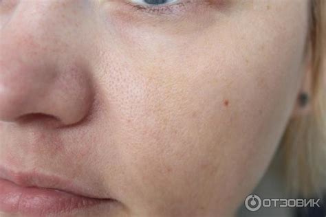 Отзыв о Фракционная мезотерапия | Фракционная мезотерапия против ...