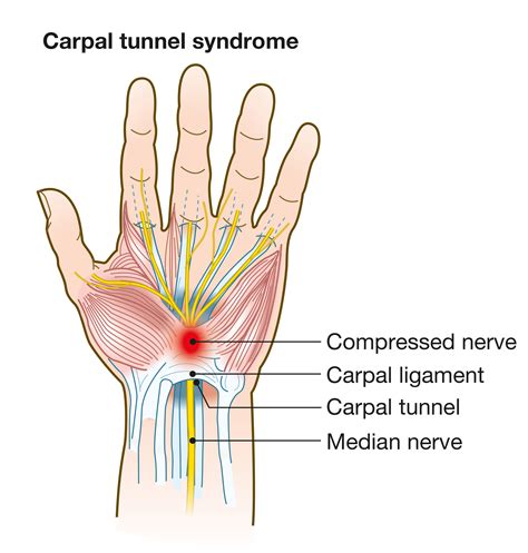 physical solutions carpal tunnel syndrome physical solutions