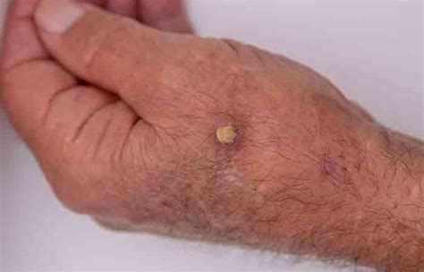 Cutaneous Horn: Causes, Diagnosis, Risk Factors, & Treatment