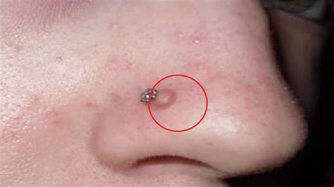 Bump Inside Nose Piercing