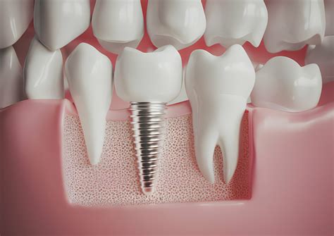 Everything You Need To Know About Dental Implants In Summerville