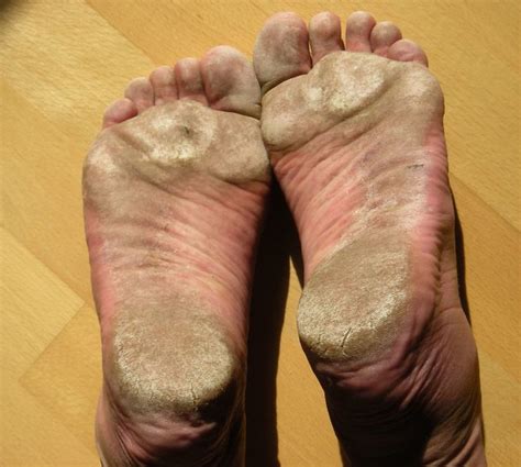 Crusty Feet