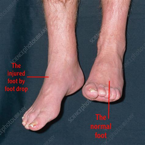 Common fibular (peroneal) nerve
